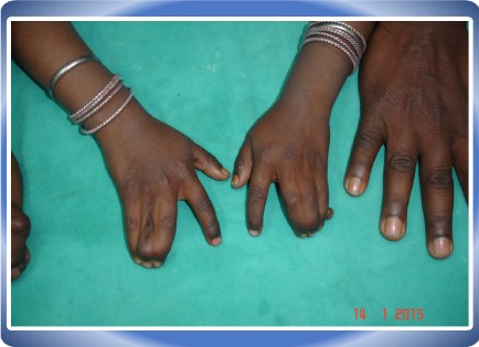 CONGENITAL ANOMALIES OF LIMB